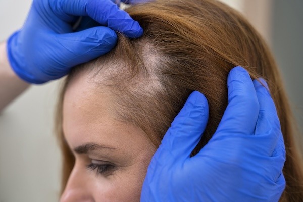 Woman getting hair loss treatment clinic