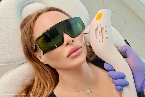 Close-up of laser skin resurfacing procedure for fine lines and texture in Miami