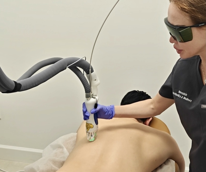 Laser hair removal device applied to a man’s back