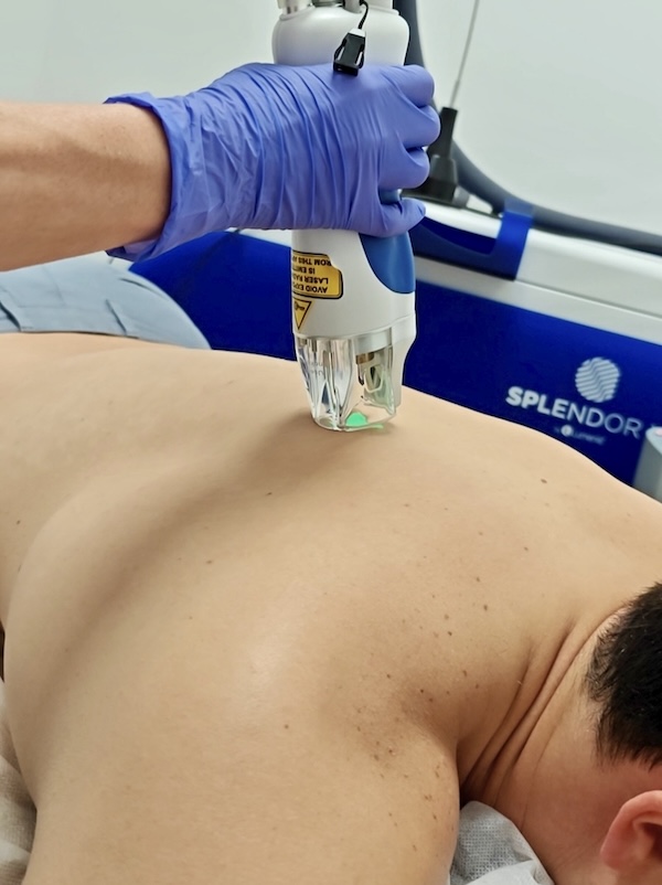 Back laser hair removal treatment in progress